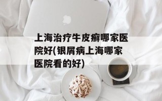 上海治疗牛皮癣哪家医院好(银屑病上海哪家医院看的好)